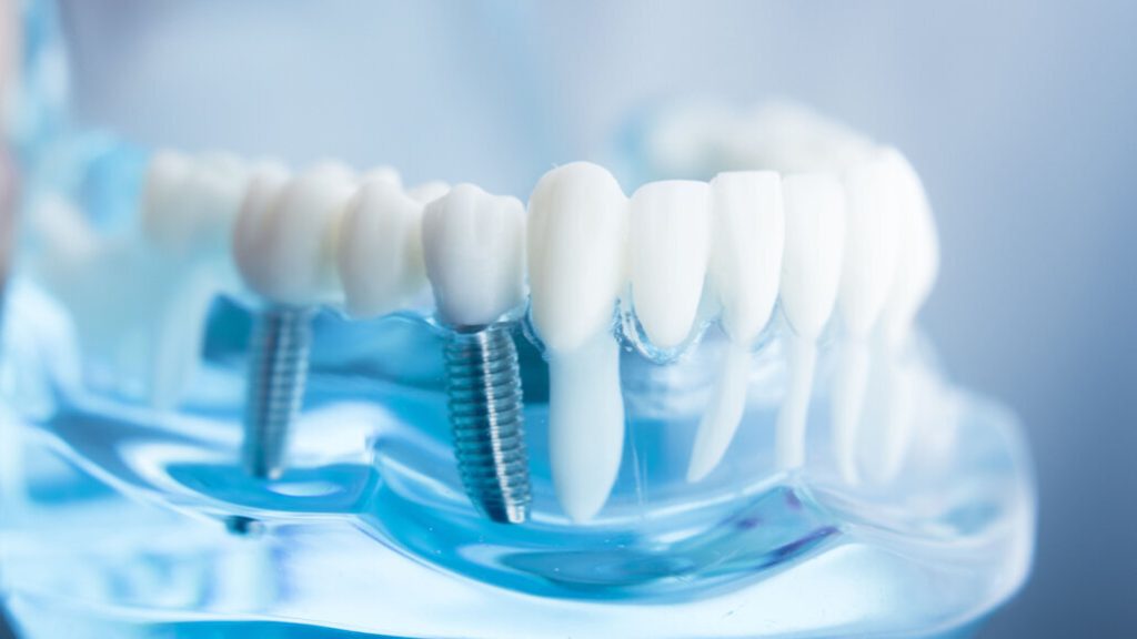 One dental implant or a full-arch restoration: how the right solution is chosen